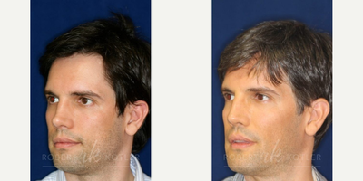 Permanent Non-surgical Rhinoplasty - Patient had prior injury that caused a collapse of the bridge. Permanent Silikon 1000 filler restored the collapsed bridge. Patient also had extended neck sculpture.