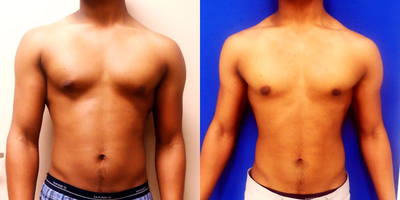 Patient Case #Gynecomastia Patient - This skinny athletic nineteen year old Baltimore gynecomastia patient was
 very bothered by what he termed puffy nipples and could not, obviously, lose more weight. 
This is because the tissue was glandular, and we got a surprisingly large gland collection which is 
pictured below.
