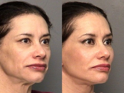 59yr old female with large cheek implants - 59 yr old female who lost 90 lbs, through vigorous exercise and dieting . Before- left Right-10 mo. after faze and eyelift and large cheek implants to restore youthful appearance.