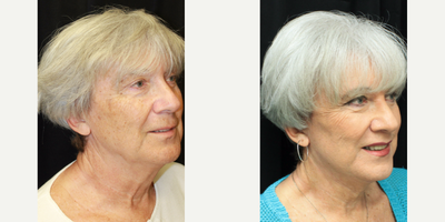 55-64 year old woman treated with Facial Feminization Surgery - FFS Surgery