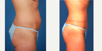 35-44 year old woman treated with Mini Tummy Tuck - concerned about lower abdominal bulge. treated with mini-tummy tuck and liposuction