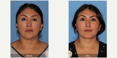 47 year old woman treated with Deep Plane Facelift, Neck Lift, Brow Lift, Buccal Fat Removal, MACS Facelift - 47 year old woman treated with Deep Plane Face and Neck Lift, Temporal Brow Lift, Buccal Fat Extraction, MAC