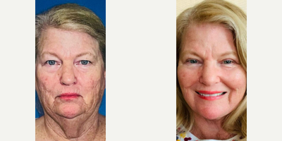 Woman treated with Facelift, Skin Tightening, Eyelid Surgery, CO2 Laser - This patient came to our office for facial and skin rejuvenation to address signs of aging. We performed the FaceologyLIFT, Upper Eyelid Blepharoplasty, and full face CO2 Laser Resurfacing.One month out from surgery, she is healing well with a radiant and subtle result that will continue to improve.