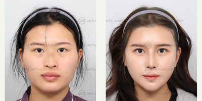 25-34 year old woman treated with Jaw Reduction, Genioplasty, Cheekbone Reduction, Facial Fat Transfer, Rhinoplasty, Asian Rhino - Mandible Jaw Reduction, Genioplasty, Cheekbone ReductionFacial Fat TransferRhinoplasty (Nose Ridge+Nose Tip+Hump Correction)