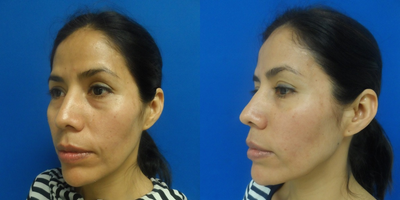 Case #restylane and fillers patient - Injected 0.5 cc restylane into each infraorbital area, and one cc in each nasolabial fold to achieve a younger and more rested appearance in a restylane patient.