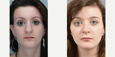 17 or under year old woman treated with Rhinoplasty - Before surgery, the patient has a bulbous nasal tip and wide nose. Her tip droops and her nasal bridge is too high. Following rhinoplasty, her nasal tip is narrowed and has better definition. Her nasal tip is rotated up and the bridge reduced.