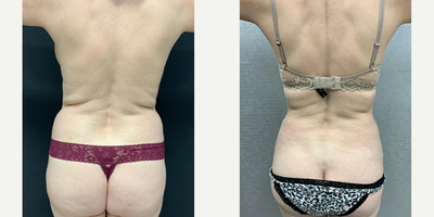Woman treated with Liposuction - Liposuction