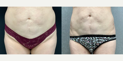 Woman treated with Liposuction - Liposuction