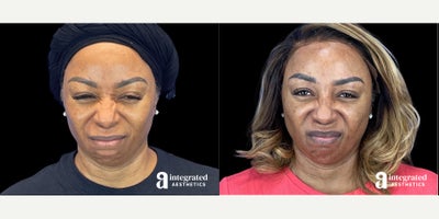 55-64 year old woman treated with Dysport - The patient is a 58-year-old female who had concerns about fine lines and wrinkles. Dr. Chiang used wrinkle relaxer (Dysport or Chotox) for the forehead, glabella, crows feet, bunny lines, chin, masseters, and neck bands to address these concerns. The after results are 3 weeks post-treatment.