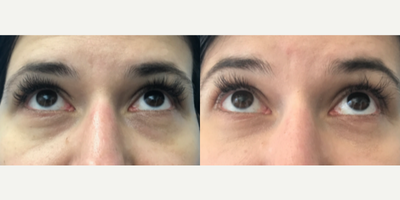 Woman treated with Dermal Fillers - Woman treated with Dermal Fillers using hyaluronic-acid fillers. Pre-op, patient was concerned with her under-eye hollowing which left her with dark shadows beneath her eyes.