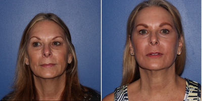 65-74 year old woman treated with YAG Laser - Sciton Yag laser resurfacing. Addresses hooding of the eyelids, skin discoloration, poor texture, and tightens. Patient was treated with one full face yag laser resurfacing treatment.