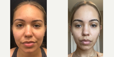 35-44 year old woman treated with Buccal Fat Removal - Buccal Fat, chin and neck liposculpting
