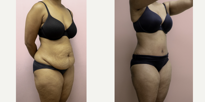 35-44 year old woman treated with Tummy Tuck - This lovely young mother has been struggling with excess abdominal fullness which has failed diet and exercise intervention. She underwent an abdominoplasty with liposuction of the flanks and is shown 2 months post-op. She is loving her results!