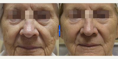 65-74 year old woman treated with Fractora RF for full face skin tightening - 65-74 year old woman treated with Fractora RF for full face skin tightening