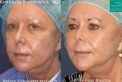 Woman treated with Silhouette InstaLift - Silhouette InstaLift to rejuvenate the face by Dr. Butterwick