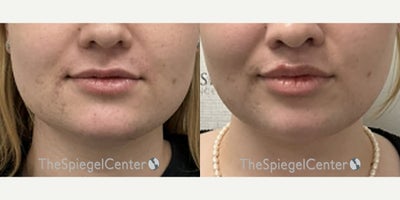 18-24 year old woman treated with Jaw Surgery - 18-24 year old woman treated with Jaw Surgery