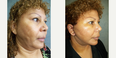 45-54 year old woman treated with Lower Face Lift - revision of facelift done elsewhere with lipo done on face, revised and repaired