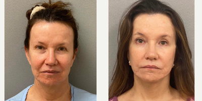 58 year old woman treated with Facelift/Neck Lift - 58 yo s/o facelift/ necklift performed under local anesthesia with sedation in our on site AAAA certified operating suite