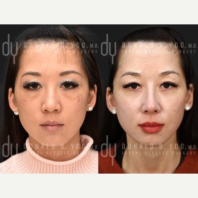 25-34 year old woman treated with Alarplasty, Asian Rhinoplasty, Rhinoplasty, Eyelid Surgery - Primary Rhinoplasty with her own rib cartilage and DCF (Diced cartilage fascia) and lower blepharoplasty