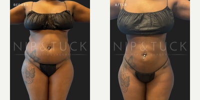 18-24 year old woman treated with Lipo 360 - 24 years old femaleWeight: 231 58BMI: 35.12Procedure taken:Liposuction 3603 Months post-op