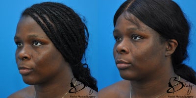 21-30 year old woman treated with Alarplasty, Brow Lift, Facial Fat Transfer - 21-30 year old woman treated with Alarplasty, Brow Lift, Facial Fat Transfer