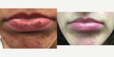 18-24 year old woman treated with PicoWay - Picoway laser used to eliminate this young woman's age spots on her lips.