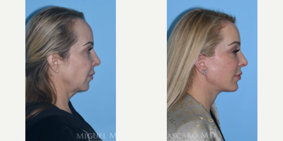 46 year old woman treated with Forehead Reduction - 46 year old woman treated with Chin Implant, Deep Plane Facelift with submandibular gland reduction, Neck Lift, Forehead Reduction, Brow Lift, baby laryngeal setback, and skin pinch.