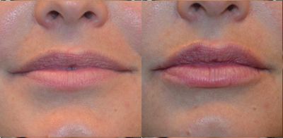 18-24 year old woman treated with Restylane Silk - before and after restylane silk to the upper and lower lips using cannula injections to limit bruising, swelling, and pain.