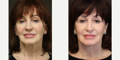 Neck lift, minimally invasive - Performed with local anesthesia only with one 3/4 inch incision.
