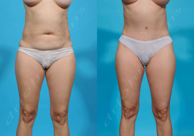 25-34 year old woman treated with Drainless Tummy Tuck - Tummy Tuck with liposuction of the flanks/love handles as part of a mommy makeover.