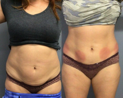 35-44 year old woman treated with Cryoskin - 6 Cryoslimming sessions on lower abdomen