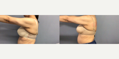 45-54 year old woman treated with Cryoskin - 5 Cryoslimming sessions on back/bra fat