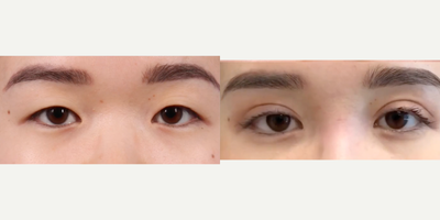 Woman treated with Double Eyelid Surgery - This patient wanted a dramatic parallel crease. She underwent a full incision #doubleeyelid surgery and #medialepicanthoplasty.
