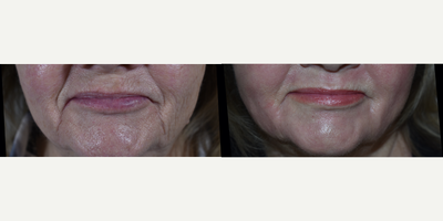 Erbium Laser Resurfacing with the Sciton MicroLaserPeel - Patient had only ONE (1) laser resurfacing with traditional Sciton Erbium laser resurfacing (not the Sciton Halo laser, the earlier version), which has a higher coefficient of absorption in skin than the CO2 laser.  Excellent for getting rid of sun damage and wrinkles in one visit.  Two weeks post procedure photo.