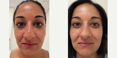 35-44 year old woman treated with Cosmetic Acupuncture - This patient underwent our 10-session Mei Zen cosmetic acupuncture series. She now has a significant reduction in undereye darkness and puffiness, as well as overall smoother skin texture, a more even complexion, less redness, and better moisture balance overall.