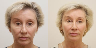 55-64 year old woman treated with Facial Fat Transfer, TCA Peel - Fat grafting and TCA peel to face