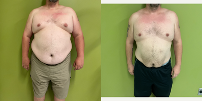 55-64 year old man treated with Semaglutide - 6 months Semaglutide treatment