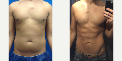 Male Slim Lipo - Before & After-selfie. This already fit patient requested ab sculpting to bring out his hard earned six pack. Male patients often identify the stomach as their 'trouble zone'; Precision Slim Liposculpting can be used to take care of fat that's resistant to diet and exercise. Performed by Justin Yovino, MD FACS at Ideal Face & Body in Beverly Hills, California