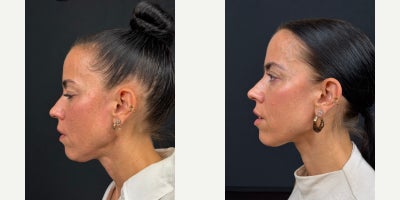 35-44 year old woman treated with Endolift, Nonsurgical Facelift - Complaining of laxity under the chin and lower face, very early loss of jawline definition.