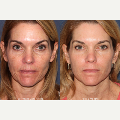 45-54 year old woman treated with Fraxel Laser - Dr. Wu treated this patient's fine lines and wrinkles with Fraxel Dual laser and filler. Results are 2 months post-op.