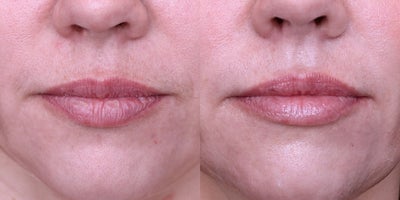 35-44 year old woman treated with Lip Fillers, Restylane Kysse - Take a look at these natural lip filler results.