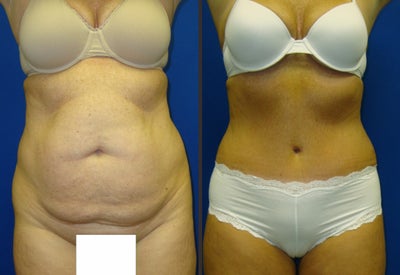 Tummy Tuck - 
	Standard Tummy tuck
