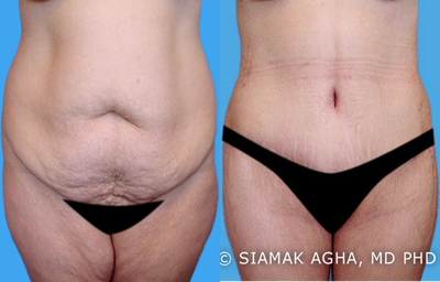 Lower Body Lift - This 36 year old female presented to Orange County Plastic Surgery for a
 lower body lift and thigh lift after losing 60 pounds of weight on her 
own.  The patient underwent a lower body lift, circumferential tummy 
tuck, buttock lift, buttock augmentation with her own tissue, 
liposuction of her back, and Dr Agha's signature 
Spiral thigh lift. Her post-operative pictures were shown at 6 weeks 
before her return back home.