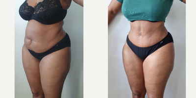 45-54 year old woman treated with Tummy Tuck, Liposuction, Liposculpture, Mommy Makeover - OP: LIPO 360 (2.5kg) and Tummy tuck (900g). 2 hour op. Recovery took 2 weeks. All swelling gone by 6 weeks to 3 months (after pic was taken 6 month later).