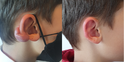 17 or under year old man treated with Ear Surgery, Earlobe Repair - Resection Keloid Earlobe 10 months later.
