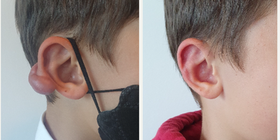 17 or under year old man treated with Ear Surgery, Earlobe Repair - Resection Keloid Earlobe 10 months later.
