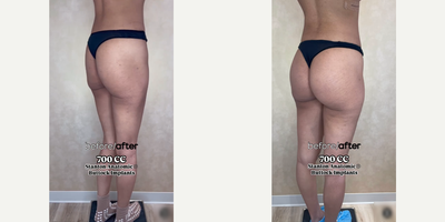 Woman treated with Butt Implants - Woman treated with Butt Implants