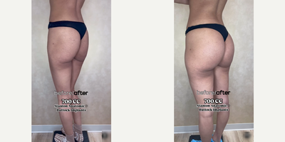 Woman treated with Butt Implants - Woman treated with Butt Implants