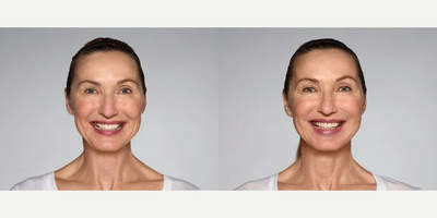 Woman treated with Restylane Refyne - 1.5 mL Restylane Refyne in nasolabial folds1.0 mL Restylane Refyne in marionette linesPhotos taken before treatment and 2 weeks after treatment