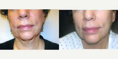 45-54 year old woman treated with Skintyte - Patient received 3 Sciton Skintyte treatments after chin and jowls Smartlipo